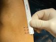 L’incisione al donatore