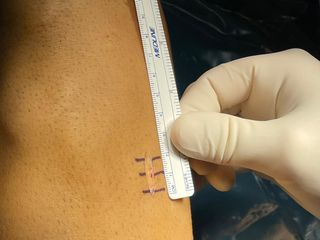 L’incisione al donatore