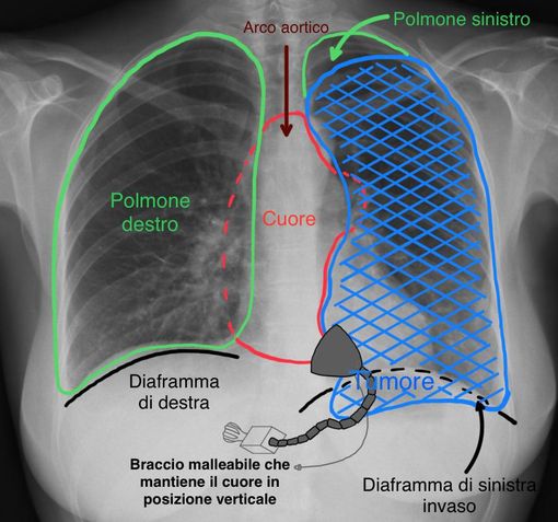 radiografia ai polmoni