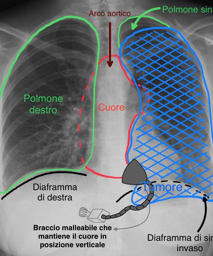 radiografia ai polmoni