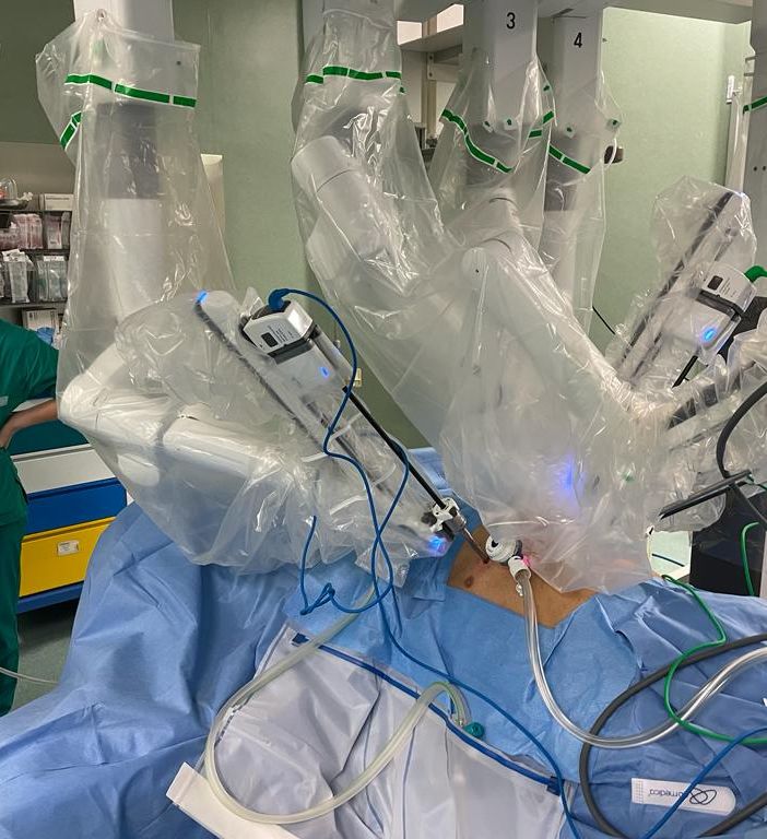 Molinette, salvata una donna con un raro tumore sul torace: per la prima volta il robot ha praticato un'unica piccola incisione