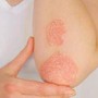 Giornata psoriasi, Ucb rinnova l'impegno contro lo stigma