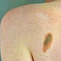 Melanoma, Adoi: "Bene nuova legge su prevenzione, dermatologo centrale in screening"