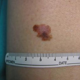 Cancro, oncologo: &quot;Tre anni per vaccino mRna contro melanoma&quot;