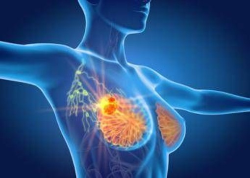 Per cancro seno la cura che arriva dal gelo, Ieo: &quot;Verso un futuro no bisturi&quot;