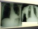 Cancro polmone, con nuova combinazione malattia sotto controllo più a lungo