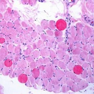 Malattie rare, risultati positivi a 5 anni per vamorolone in distrofia Duchenne Malattie rare, risultati positivi a 5 anni per vamorolone in distrofia Duchenne