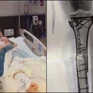 Milano Cortina, Vonn mostra la gamba dopo le operazioni: "Dolore difficile da gestire" Milano Cortina, Vonn mostra la gamba dopo le operazioni: "Dolore difficile da gestire"