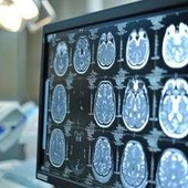 Telemedicina, progetto telestroke permette di trattare ictus a distanza