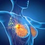 Per cancro seno la cura che arriva dal gelo, Ieo: &quot;Verso un futuro no bisturi&quot;
