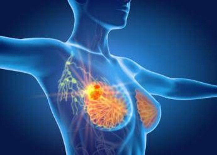 Per cancro seno la cura che arriva dal gelo, Ieo: &quot;Verso un futuro no bisturi&quot;