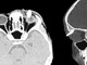 Ha un gonfiore sotto l'occhio, in ospedale scoprono che ha un dente nella palpebra: lo strano caso in India