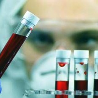 Tumori, Ue approva terapia per adulti con leucemia linfatica cronica refrattaria