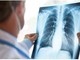 Cancro polmone Egfr-mutato, studio fase 3 Adaura: "Il 79% dei pazienti vivo a 8 anni con Osimertinib" Cancro polmone Egfr-mutato, studio fase 3 Adaura: "Il 79% dei pazienti vivo a 8 anni con Osimertinib"