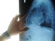 Radiologia interventistica, Ssn e fondazioni per cure più accessibili Radiologia interventistica, Ssn e fondazioni per cure più accessibili