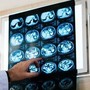 Nodulo polmonare: che cos’è, come si diagnostica e quando intervenire