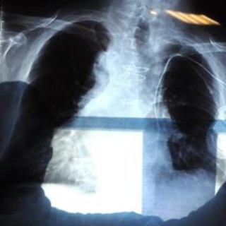 Cancro polmone, nuova terapia orale riduce del 44% il rischio di morte Cancro polmone, nuova terapia orale riduce del 44% il rischio di morte