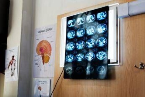 Di Battista, cosa indica un mal di testa forte e improvviso: le ipotesi del neurologo Di Battista, cosa indica un mal di testa forte e improvviso: le ipotesi del neurologo