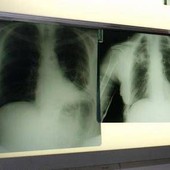Cancro polmone, con nuova combinazione malattia sotto controllo più a lungo Cancro polmone, con nuova combinazione malattia sotto controllo più a lungo