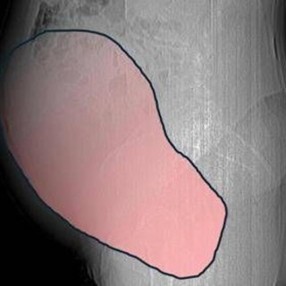 Intervento record al Sant'Anna di Torino, rimosso tumore ovarico di 6 kg Intervento record al Sant'Anna di Torino, rimosso tumore ovarico di 6 kg