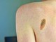 Melanoma, la firma mutazionale del cancro potrà cambiare la cura Melanoma, la firma mutazionale del cancro potrà cambiare la cura