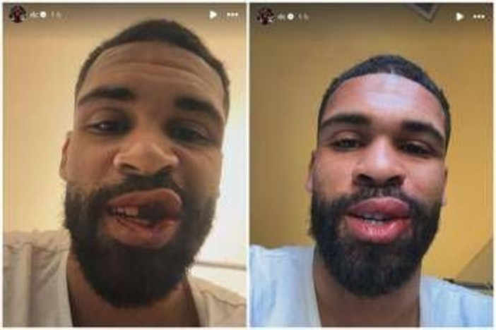 Loftus-Cheek, intervento riuscito alla mascella. E mostra foto dopo scontro in Milan-Parma