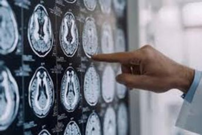 Centro Dbs Pavia, 100 interventi di neurostimolazione profonda per Parkinson Centro Dbs Pavia, 100 interventi di neurostimolazione profonda per Parkinson