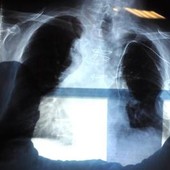 Cancro al polmone aggressivo, combinazione farmaci riduce del 58% rischio morte Cancro al polmone aggressivo, combinazione farmaci riduce del 58% rischio morte