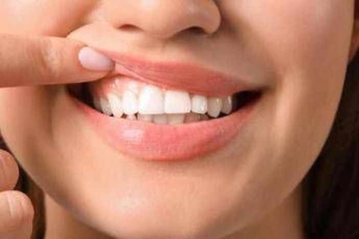 Denti a rischio tra i giovani, Sidp: "Il 36% della Gen Z ha gengive che sanguinano" Denti a rischio tra i giovani, Sidp: "Il 36% della Gen Z ha gengive che sanguinano"