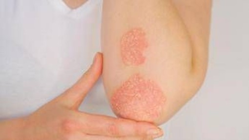 Giornata psoriasi, Ucb rinnova l'impegno contro lo stigma
