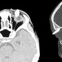Ha un gonfiore sotto l'occhio, in ospedale scoprono che ha un dente nella palpebra: lo strano caso in India