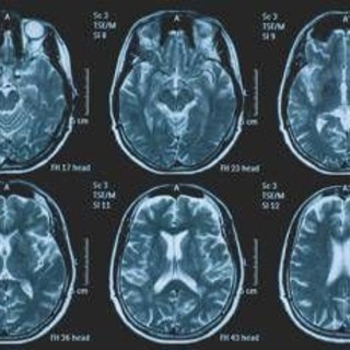 Una persona su 3 ha un disturbo neurologico, a Napoli arriva BrainSpace House Una persona su 3 ha un disturbo neurologico, a Napoli arriva BrainSpace House