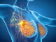 Cancro seno, con profilazione molecolare e terapie target migliori prospettive di cura Cancro seno, con profilazione molecolare e terapie target migliori prospettive di cura