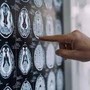 Stop tremori Parkinson senza bisturi, 10 pazienti curati con ultrasuoni a Napoli