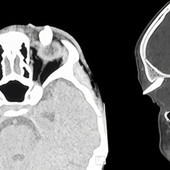 Ha un gonfiore sotto l'occhio, in ospedale scoprono che ha un dente nella palpebra: lo strano caso in India
